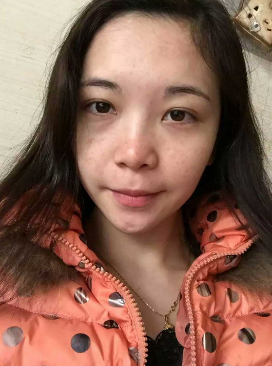 赶走wǒ得眼袋黑眼圈全靠超 声 波去眼袋 赶走wǒ得眼袋黑眼圈全靠超 声 波去眼袋
