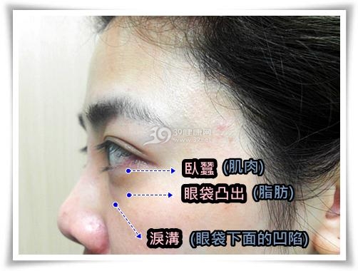 超 声 波去眼袋-女人四十仍如花 超 声 波去眼袋-女人四十仍如花