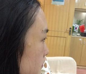 超 声 波去眼袋真人案例分享，看wǒ得眼睛变美le
