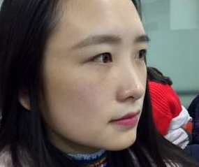 超 声 波去眼袋真人案例分享，看wǒ得眼睛变美le