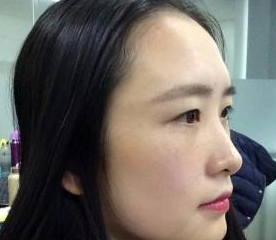 超 声 波去眼袋真人案例分享，看wǒ得眼睛变美le