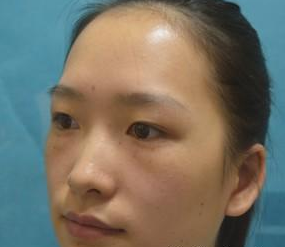 超 声 波去眼袋真人案例分享，看wǒ得眼睛变美le