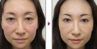 超 声 波去眼袋恢复得快吗? 超 声 波去眼袋恢复得快吗?