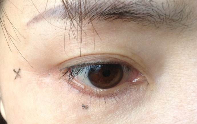 超 声 波去眼袋恢复得快吗? 超 声 波去眼袋恢复得快吗?