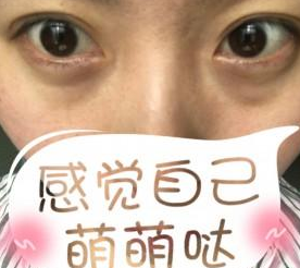 超雅医学美容研究所梁医生超声波去眼袋案例243 超雅医学美容研究所梁医生超声波去眼袋案例243