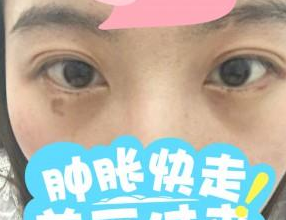超雅医学美容研究所梁医生超声波去眼袋案例243 超雅医学美容研究所梁医生超声波去眼袋案例243