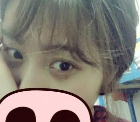 超雅医学美容研究所梁医生超声波去眼袋案例243 超雅医学美容研究所梁医生超声波去眼袋案例243