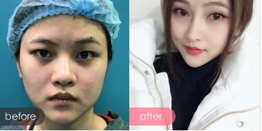 超声波去眼袋让我顺利返岗工作145 超声波去眼袋让我顺利返岗工作145
