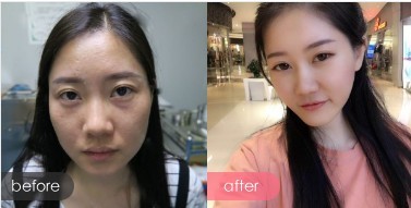 超声波去眼袋让我摆脱大眼袋990 超声波去眼袋让我摆脱大眼袋990