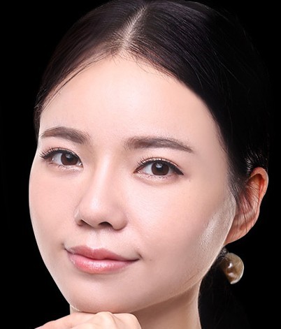 两位超声波去眼袋者的术后日记153 两位超声波去眼袋者的术后日记153