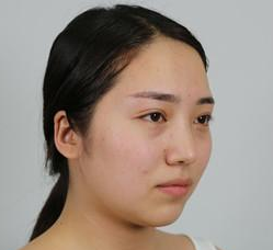 超声波瘦脸消除掉脸上的肉肉036 超声波瘦脸消除掉脸上的肉肉036