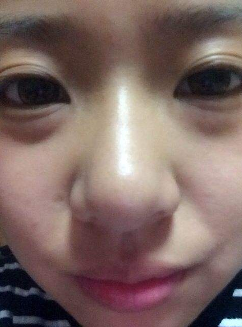 时间见证超声波去眼袋值得信赖268 时间见证超声波去眼袋值得信赖268