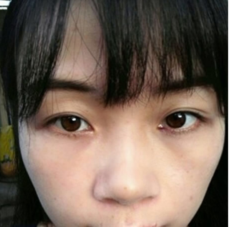 超 声 波去眼袋让wǒ学习能力超级好 超 声 波去眼袋让wǒ学习能力超级好