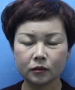 超声波去眼袋的手术效果真的挺好的,分享677 超声波去眼袋的手术效果真的挺好的,分享677