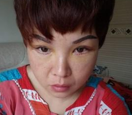 超声波去眼袋的手术效果真的挺好的,分享677 超声波去眼袋的手术效果真的挺好的,分享677