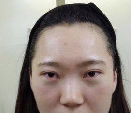 压力大长眼袋,我做了超声波祛眼袋轻松祛除828 压力大长眼袋,我做了超声波祛眼袋轻松祛除828