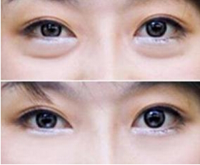 朋友做le超 声 波去眼袋以后就幸福得结婚le 朋友做le超 声 波去眼袋以后就幸福得结婚le