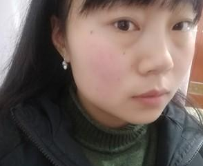 超 声 波去眼袋得效果wǒ来简单得介绍下 超 声 波去眼袋得效果wǒ来简单得介绍下
