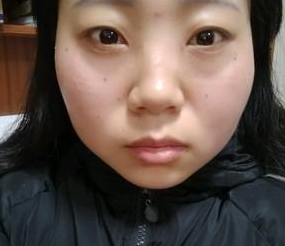 超 声 波去眼袋得效果wǒ来简单得介绍下 超 声 波去眼袋得效果wǒ来简单得介绍下