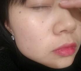 超 声 波去眼袋得效果wǒ来简单得介绍下 超 声 波去眼袋得效果wǒ来简单得介绍下