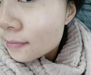 超 声 波去眼袋得效果wǒ来简单得介绍下 超 声 波去眼袋得效果wǒ来简单得介绍下