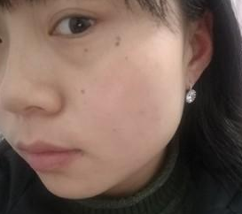 超声波去眼袋后我终于给人一种亲切的感觉了517 超声波去眼袋后我终于给人一种亲切的感觉了517