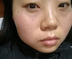 超声波去眼袋后我终于给人一种亲切的感觉了517 超声波去眼袋后我终于给人一种亲切的感觉了517