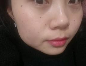超声波去眼袋后我终于给人一种亲切的感觉了517 超声波去眼袋后我终于给人一种亲切的感觉了517