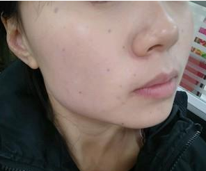 超声波去眼袋后我终于给人一种亲切的感觉了517 超声波去眼袋后我终于给人一种亲切的感觉了517
