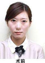 超声波去眼袋让我对生活重新燃起了希望124 超声波去眼袋让我对生活重新燃起了希望124