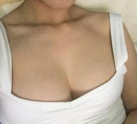真人案例:超 声 波自体脂肪丰胸手术 真人案例:超 声 波自体脂肪丰胸手术