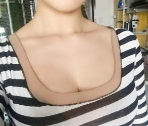 真人案例:超 声 波自体脂肪丰胸手术 真人案例:超 声 波自体脂肪丰胸手术