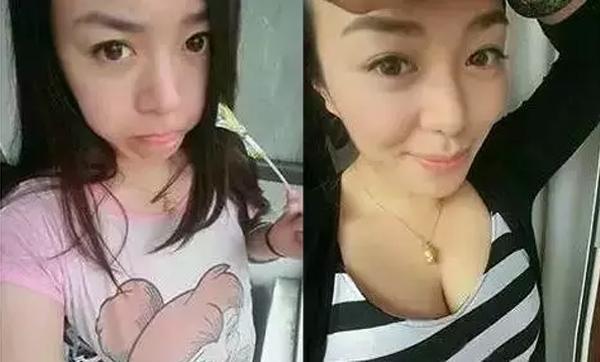 小胸妹子的福音超声波自体脂肪丰胸409 小胸妹子的福音超声波自体脂肪丰胸409