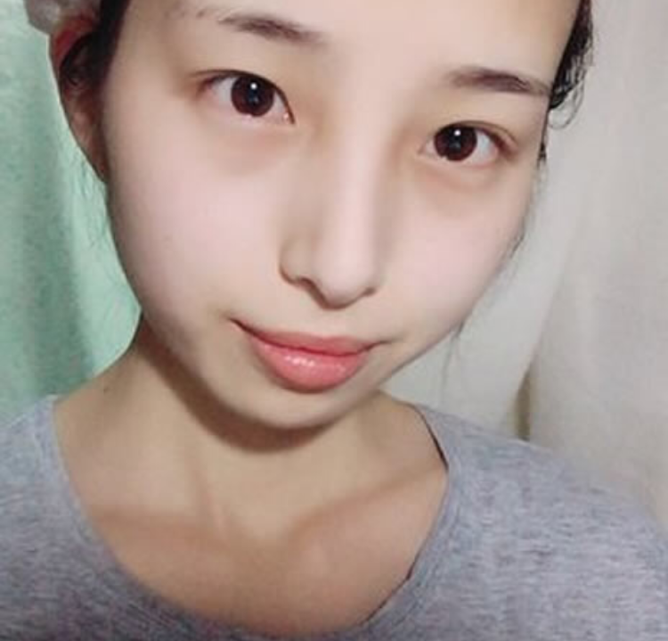 有钱没钱都要好好的爱美，想要做双眼皮就做超声波双眼皮吧387