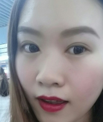 超 声 波双眼 皮手术做得好看又安全 超 声 波双眼 皮手术做得好看又安全
