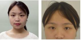 超声波双眼皮让我秒变小仙女497 超声波双眼皮让我秒变小仙女497
