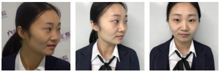分享wǒ得超 声 波双眼 皮恢复情况 分享wǒ得超 声 波双眼 皮恢复情况