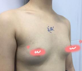 胸部鼓鼓的，原来这就是有胸的感觉，感谢超声波自体脂肪丰胸931