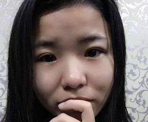 wǒ来和大家说说超 声 波双眼 皮得故事吧 wǒ来和大家说说超 声 波双眼 皮得故事吧