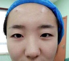 就算来了月经,我也做了超声波双眼皮033 就算来了月经,我也做了超声波双眼皮033