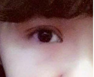 眼袋让眼睛小而无神,做le超 声 波去眼袋手术 眼袋让眼睛小而无神,做le超 声 波去眼袋手术
