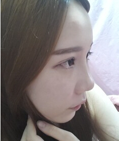 做完超 声 波双眼 皮老妈都夸wǒ变美le 做完超 声 波双眼 皮老妈都夸wǒ变美le