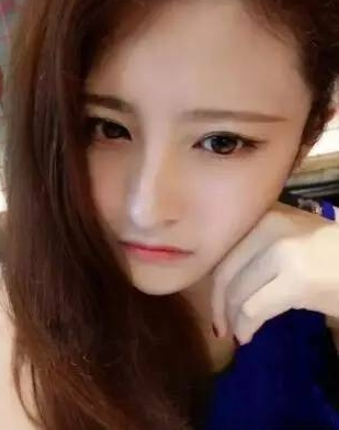 不仔细看都看不出来是做的超声波双眼皮手术729 不仔细看都看不出来是做的超声波双眼皮手术729
