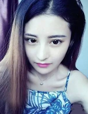 不仔细看都看不出来是做的超声波双眼皮手术729 不仔细看都看不出来是做的超声波双眼皮手术729