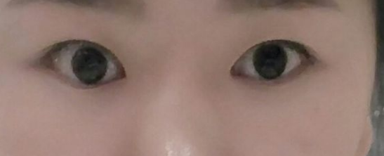 做的超声波双眼皮记录一下591 做的超声波双眼皮记录一下591