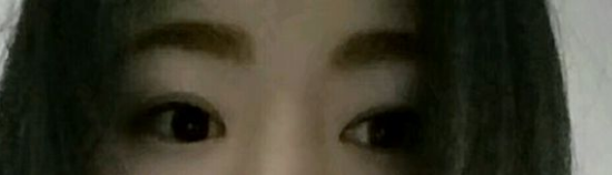 做的超声波双眼皮记录一下591 做的超声波双眼皮记录一下591