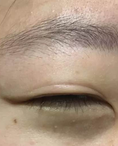 厚眼 皮选择做超 声 波双眼 皮没错 厚眼 皮选择做超 声 波双眼 皮没错
