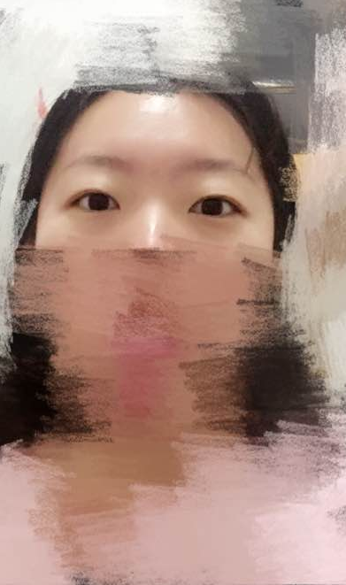 厚眼 皮选择做超 声 波双眼 皮没错 厚眼 皮选择做超 声 波双眼 皮没错