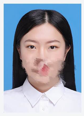 厚眼 皮选择做超 声 波双眼 皮没错 厚眼 皮选择做超 声 波双眼 皮没错