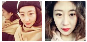 为什么推荐超 声 波去眼袋 为什么推荐超 声 波去眼袋